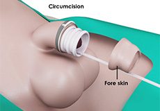 Circumcision