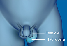 Hydrocele