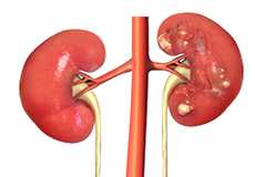 Kidney Cancer