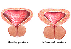 Neurogenic Bladder