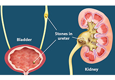 Urinary Stones